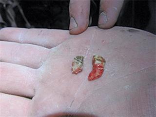 Removing wolf teeth