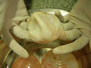 Dealing with hydatid disease Dealing with hydatid disease