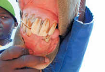 Dealing with a fractured jaw