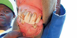 Dealing with a fractured jaw